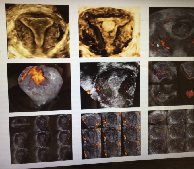 Un estudio confirma la utilidad de la ecografía 3D en el diagnóstico del cáncer de endometrio