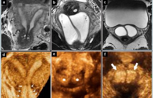 Dexeus Mujer participates in a SEGO Guide for ultrasound diagnosis of uterine malformations