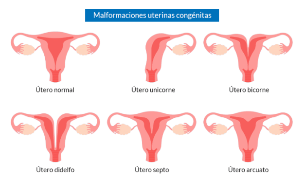Útero septo y fertilidad: ¿es recomendable operar?
