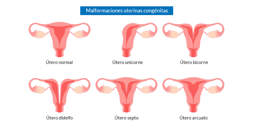 Útero septo y fertilidad: ¿es recomendable operar?