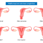 Úter septat i fertilitat: és recomanable operar?