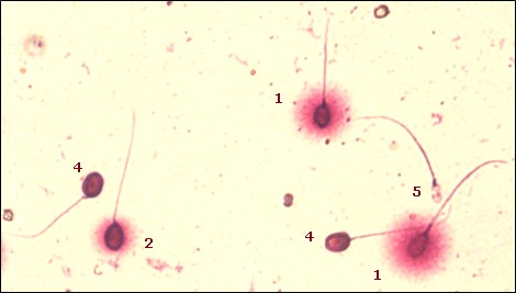 Imagen de una muestra seminal tratada para el análisis de la fragmentación del ADN