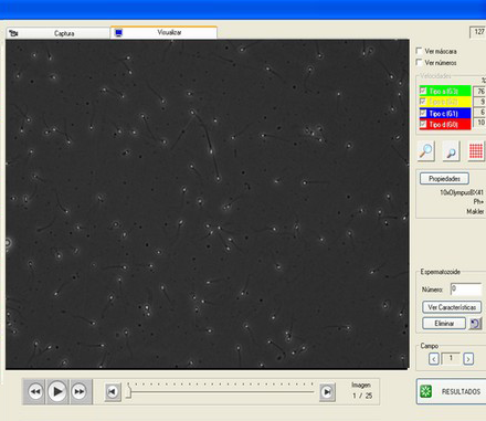 Microfotografías de una normozoospermia realizadas mediante el programa Sperm Class Analyzer