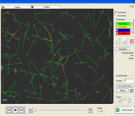 Microfotografías de una normozoospermia realizadas mediante el programa Sperm Class Analyzer