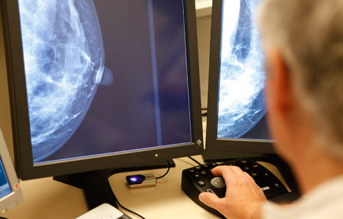 Un estudio aporta nuevos datos sobre la relación entre alta densidad mamaria y el riesgo de cáncer de mama