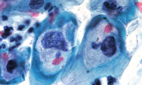 Imagen citológica de células infectadas por VPH