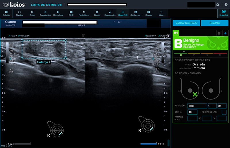 Ecografías mamarias evaluadas con inteligencia artificial en el estudio publicado en Diagnostics