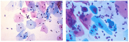 Papanicolaou celulas anormales - Papanicolaou anormal y vph positivo, #cancercervical