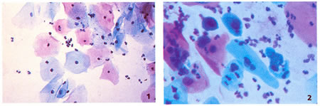 Citología normal y Citología anormal (condiloma)
