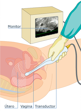 Ecografía transvaginal