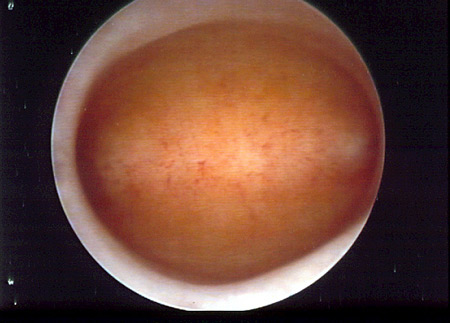Visión del interior del útero por histeroscopia