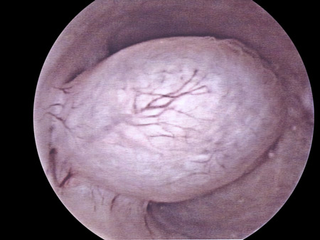 isteroscopia papilloma virus