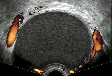 Imagen ecográfica de un endometrioma