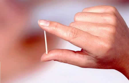 Métodos hormonales - Implante anticonceptivo