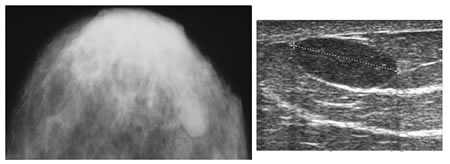 Mamografía - Fibroadenoma