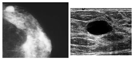 Mamografía - Quiste simple