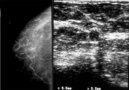 Imagen mamográfica y ecográfica de un cáncer de mama