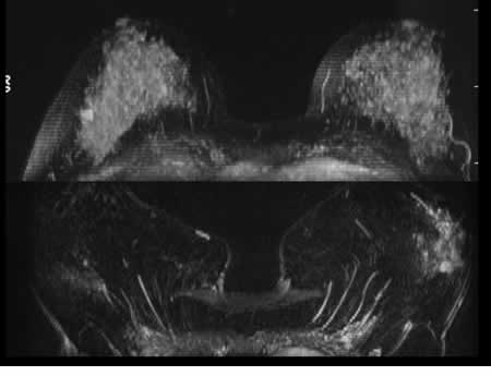 Estudio bilateral mediante resonancia magnética