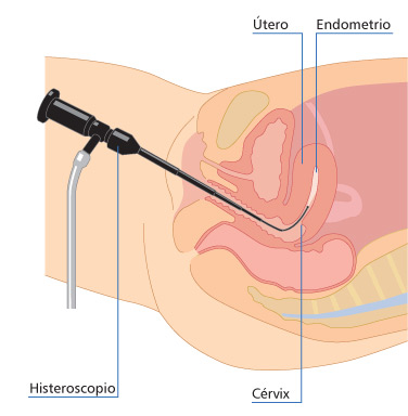 Endoscopia Ginecológica