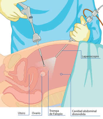 Técnica de realización de la Laparoscopia