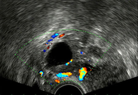 Visión del ovario en edad fértil por ecografía