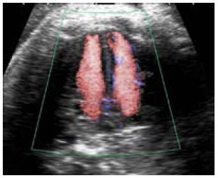 Ecocardografía con tecnología Doopler color