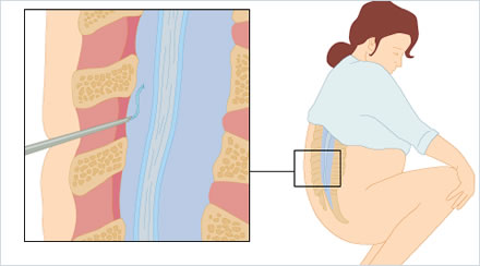 Epidural - Bloqueo reversible de las raíces nerviosas