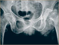 Osteoporosis - Cadera