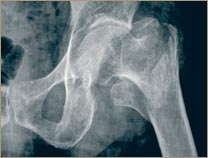 Osteoporosis - Fémur