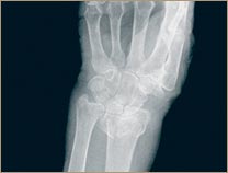 Osteoporosis - Muñeca