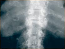 Osteoporosis - Vértebras