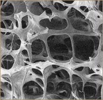 La osteoporosis y el calcio - Hueso Osteoporósico