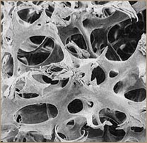 La osteoporosis y el calcio - Hueso Sano