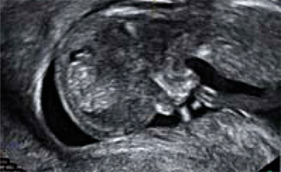 Diagnóstico prenatal molecular (Array CGH) - Resultados