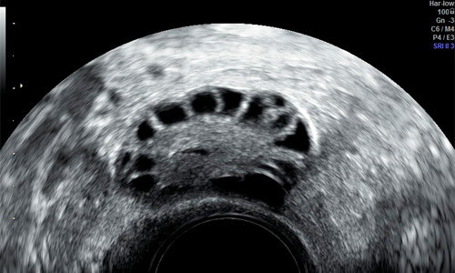 Visión del ovario en edad fértil por ecografía