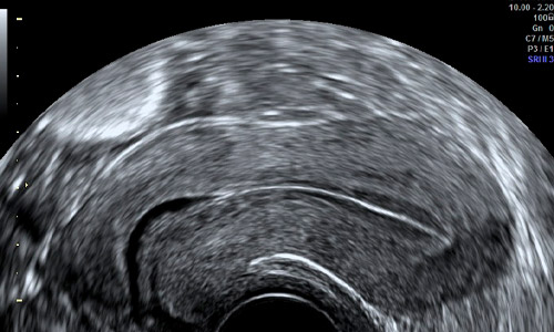 Visión del útero por ecografía