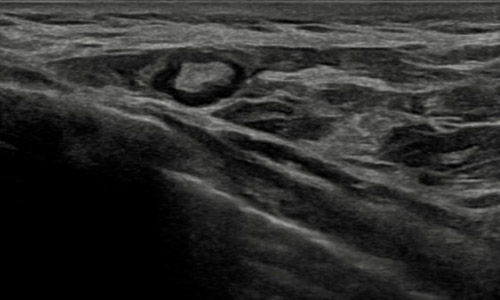 Ganglio axilar normal en ecografía