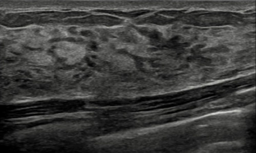 Cómo se ve el tejido mamario en una ecografía