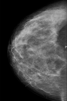 Visión de una mamografía