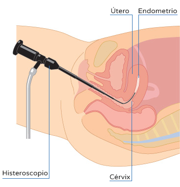 Histeroscopia - Cómo se realiza