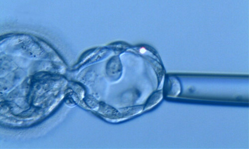 DGP - Biopsia embrionaria realizada en estadio de blastocisto
